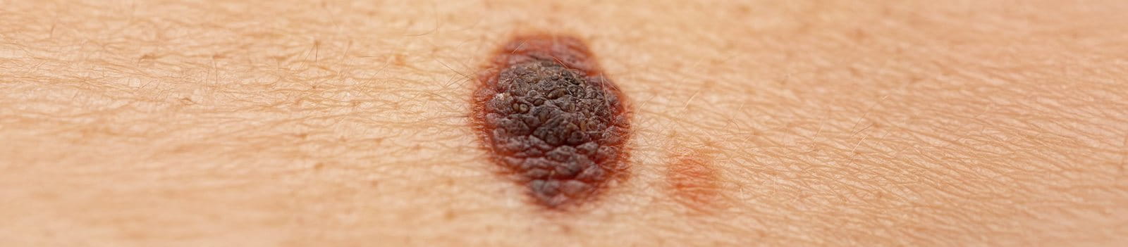 lesione cutanea di cheratosi seborroica di colore scuro con superficie irregolare