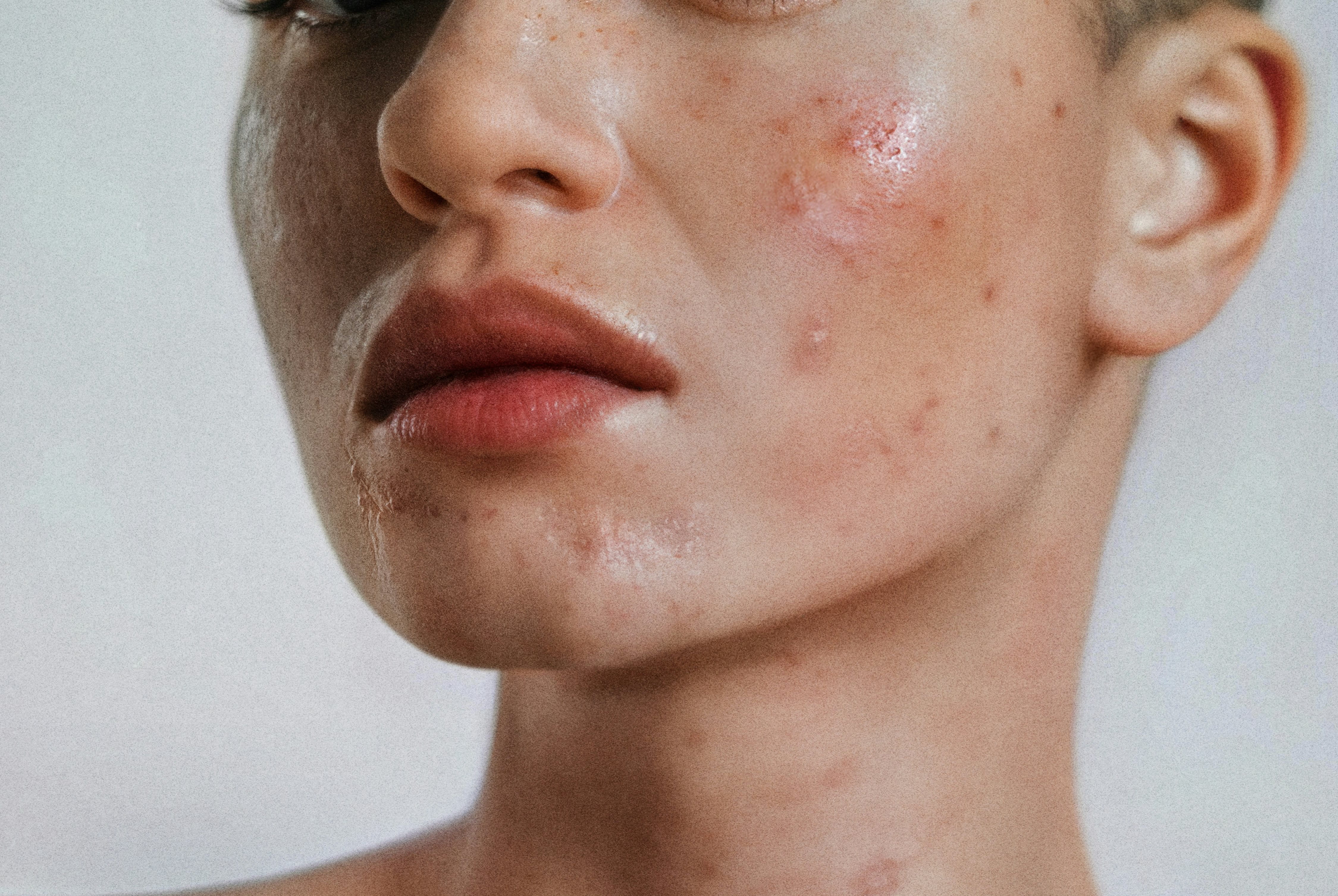 A woman with skin purging