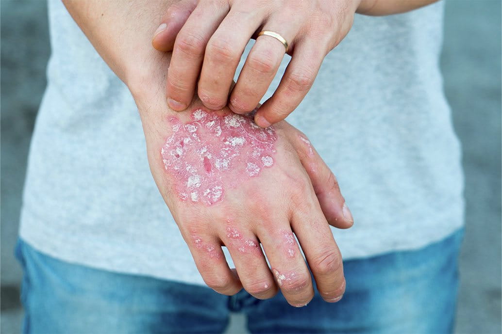 mano con psoriasi a placche visibilmente arrossata e desquamata