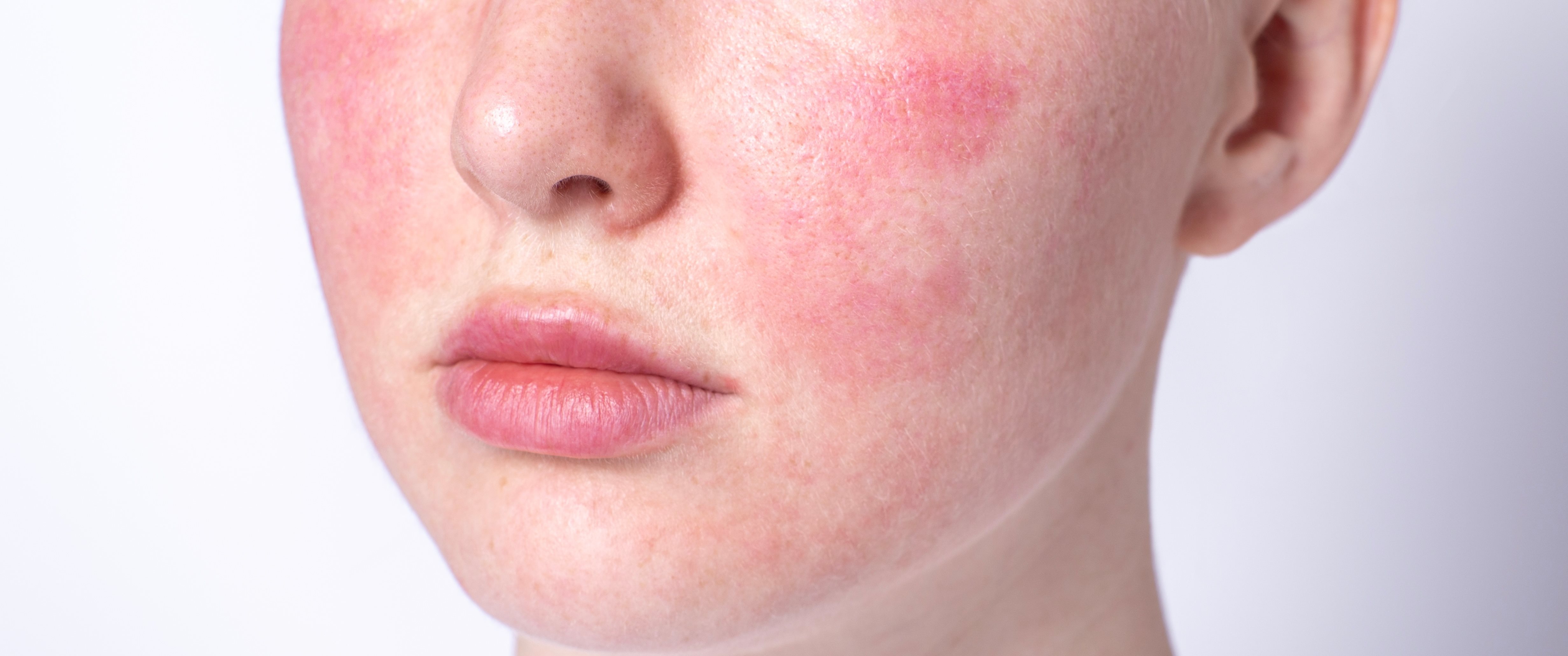 Nahaufnahme eines Gesichts mit geröteten und gereizten Hautstellen auf den Wangen. Die Person zeigt deutliche Anzeichen von Hautirritationen, die auf einen Hautausschlag durch Stress oder eine entzündliche Hauterkrankung hindeuten könnten.