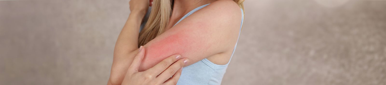 Orticaria solare sul braccio