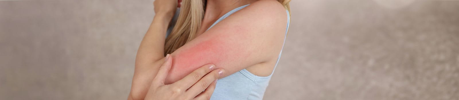 Orticaria solare sul braccio