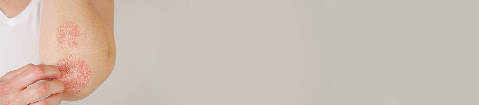 Eruzione cutanea da psoriasi sul braccio di una donna che si gratta la pelle irritata