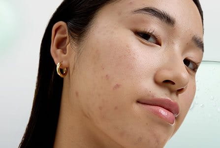 Persona conociendo los tratamientos del acné adolescente