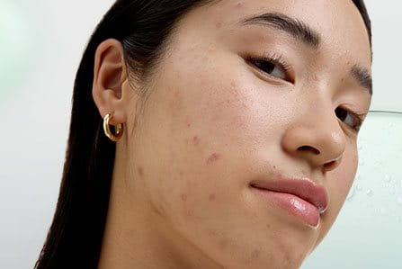 Persona conociendo los tratamientos del acné adolescente