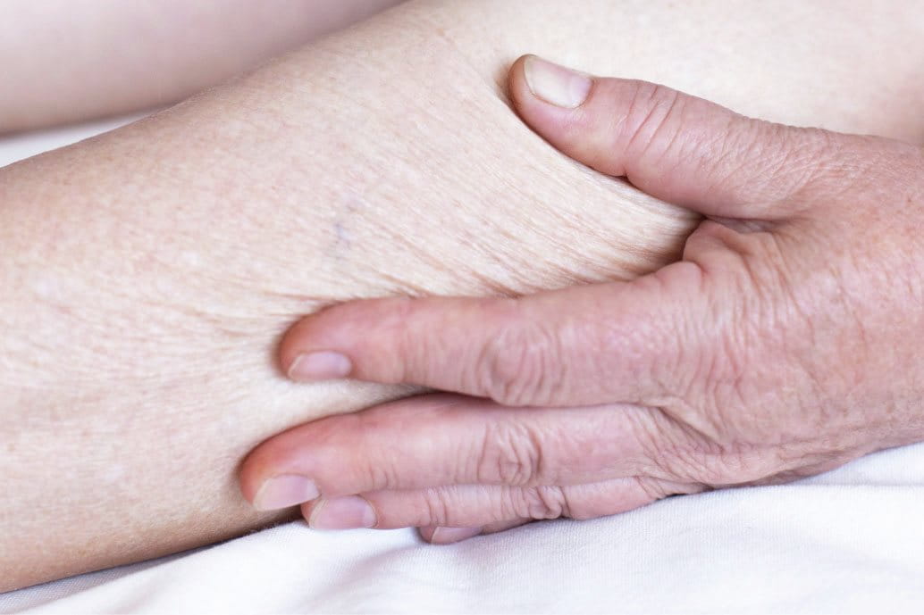 atrofia cutanea nelle gambe