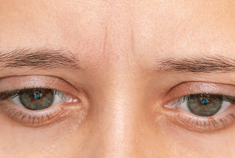 Frau vor dem Spiegel mit sichtbaren Stirn- und Zornesfalten.