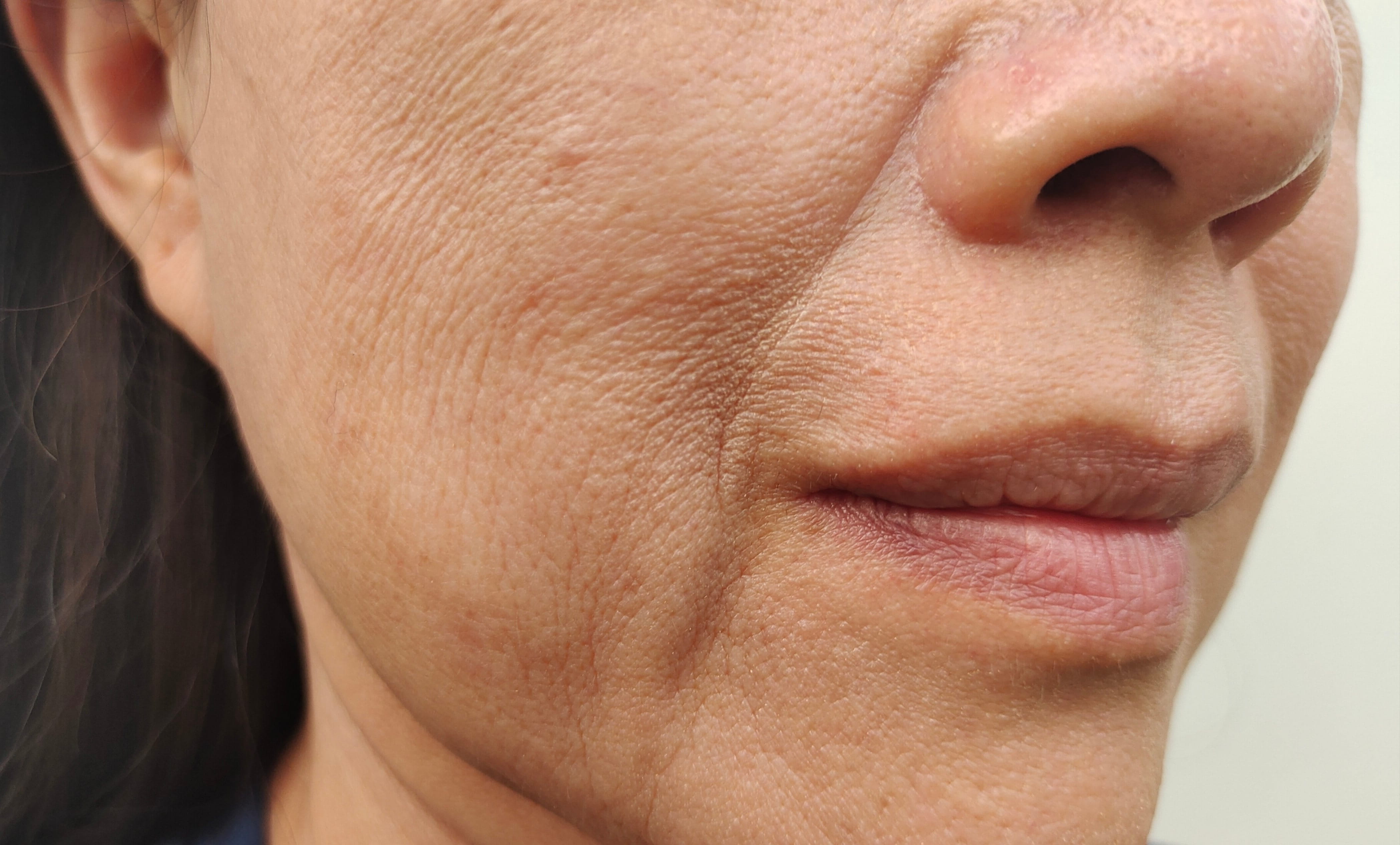 Nahaufnahme der unteren Gesichtshälfte einer erwachsenen Person mit sichtbarer Hautstruktur, feinen Linien, leichten Falten und dünner Haut.