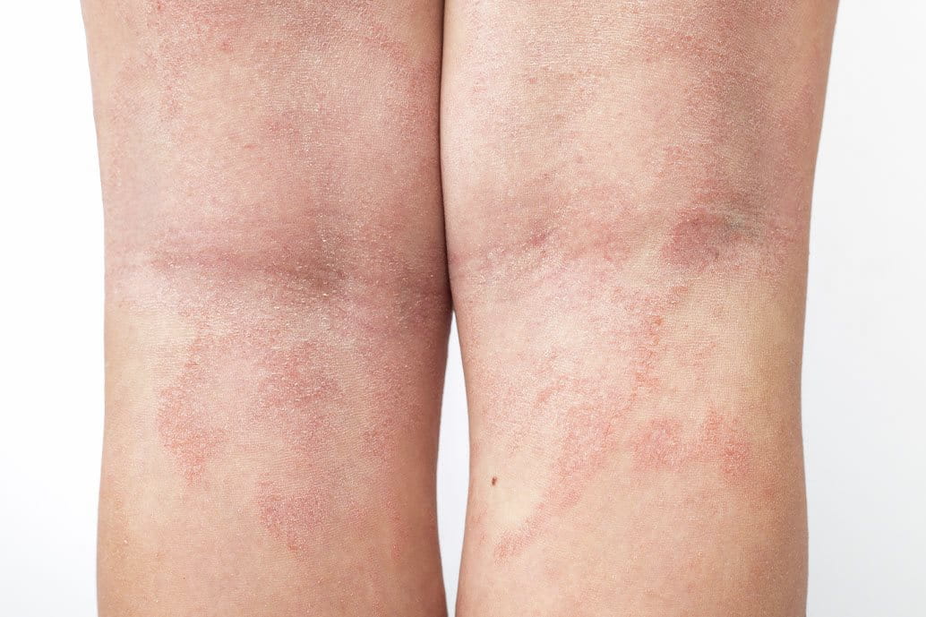 Lesioni cutanee da parapsoriasi su entrambe le gambe