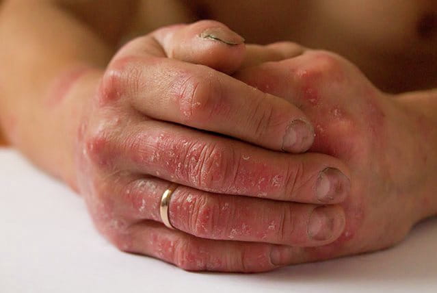 Mani con lesioni infiammate, arrossate e desquamate, sintomo visibile di psoriasi pustolosa palmare