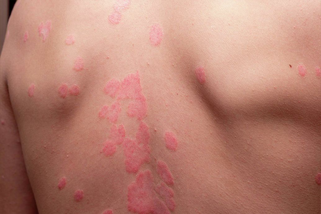 Giovane uomo con eruzione cutanea di pitiriasi rosea sulla schiena