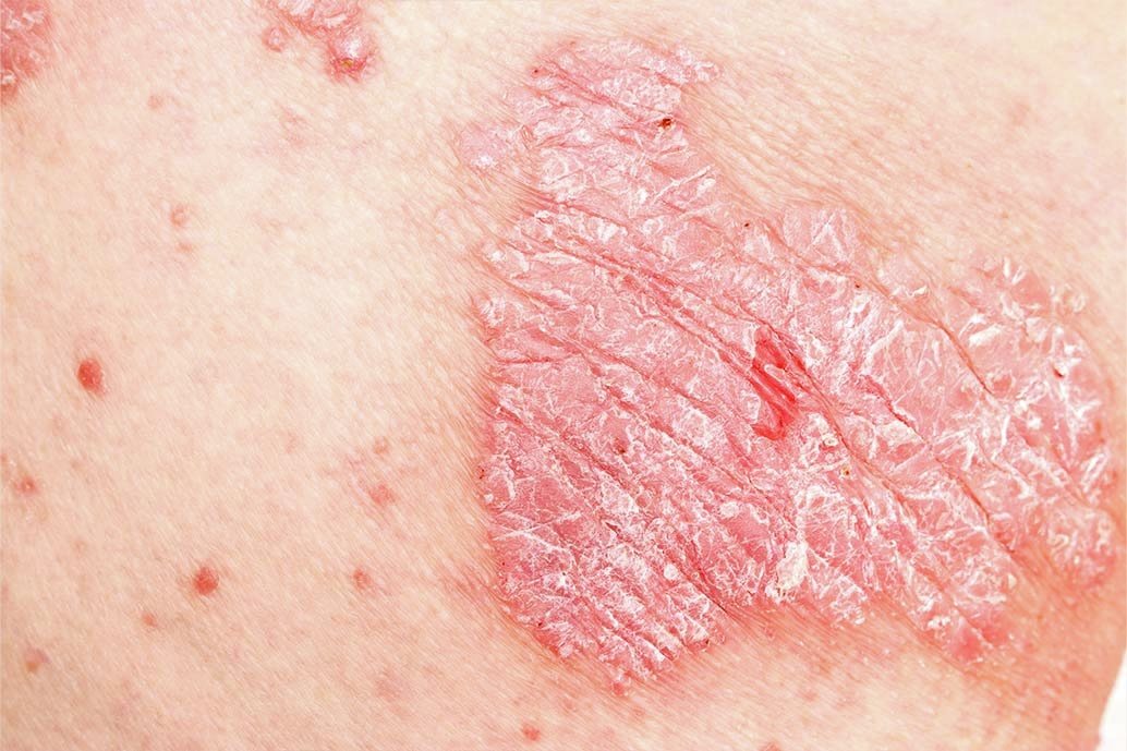 Confronto visivo tra pitiriasi rosea, psoriasi e rosacea su pelle 