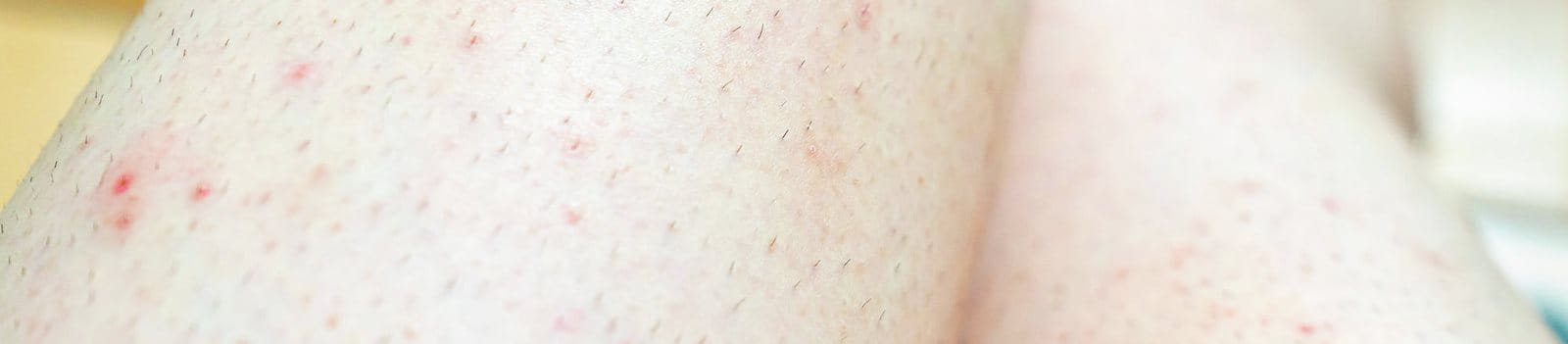 Gambe con puntini rossi e irritazione cutanea dopo depilazione.