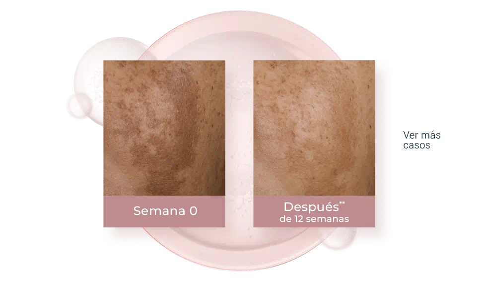 Resultados del uso de Dual Serum en 12 semanas