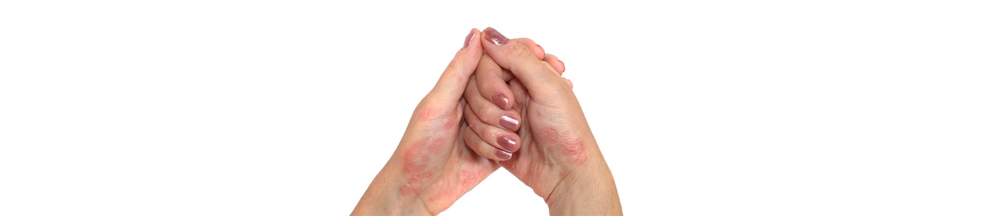  foto di ragazza con psoriasi mani 