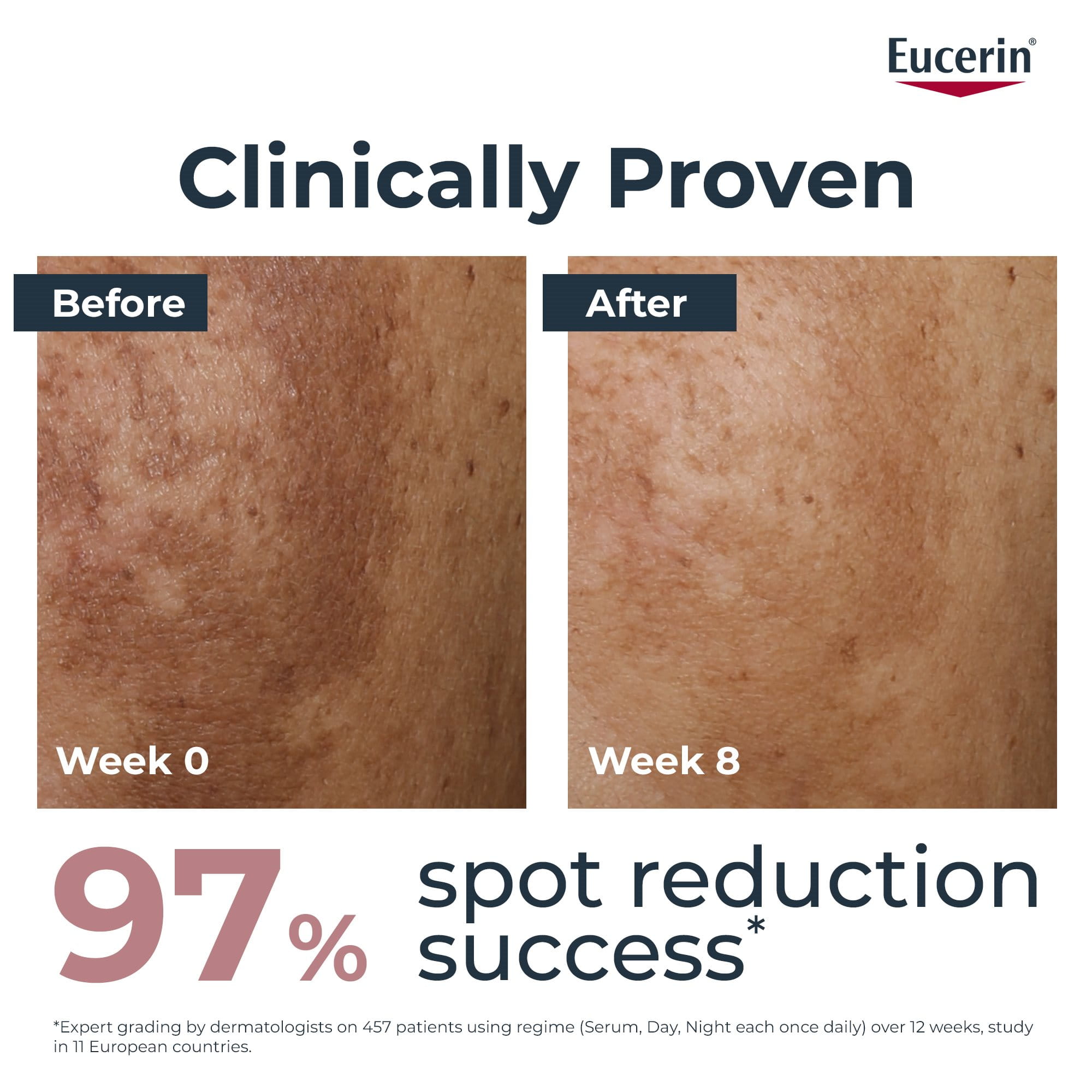 A study result of before and after using Eucerin Anti Pigment Dual Serum