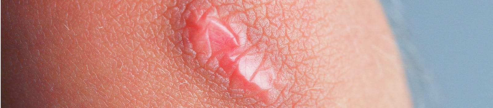 Piaga da decubito in fase iniziale sulla pelle, con piccola lesione arrossata e rialzata