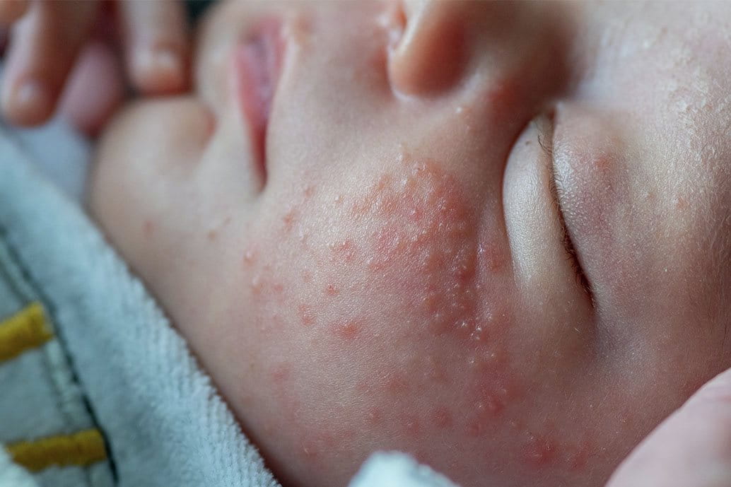 Guancia di un neonato con acne neonatale, caratterizzata da puntini rossi e arrossamento della pelle.