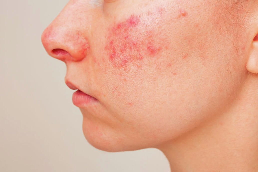 Primo piano di una donna con pelle sensibile e capillari visibili sulla guancia