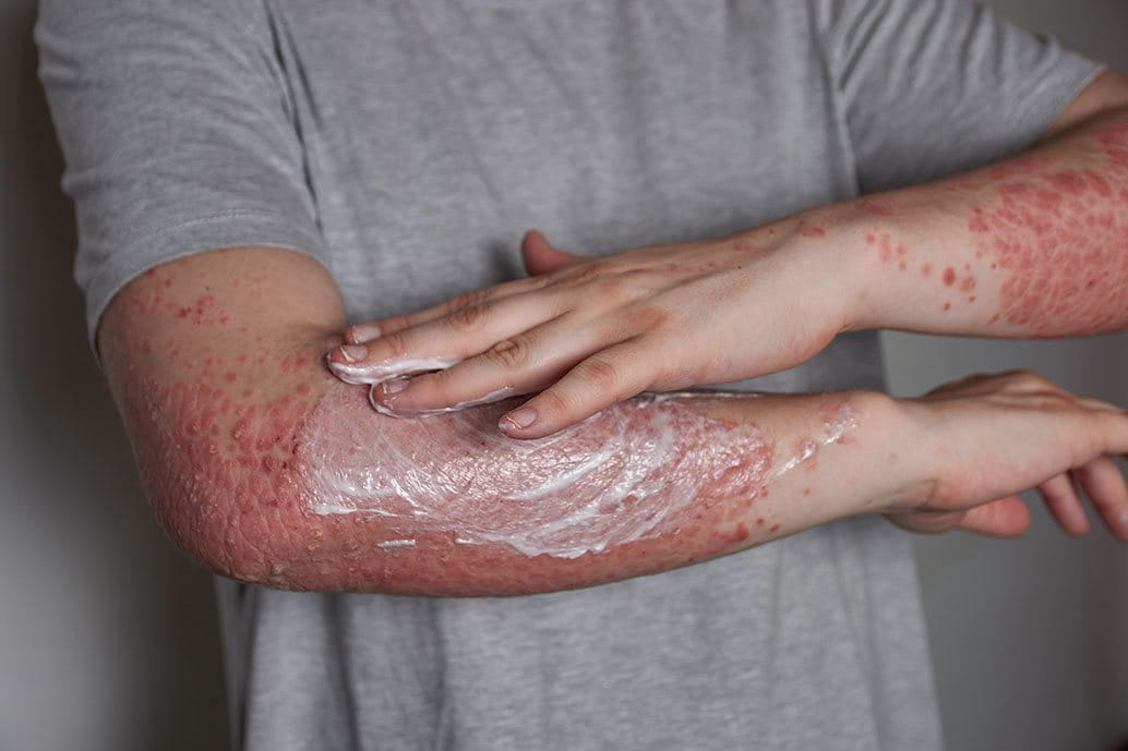 Persona che applica una crema idratante su un braccio affetto da psoriasi con pelle arrossata e squamosa