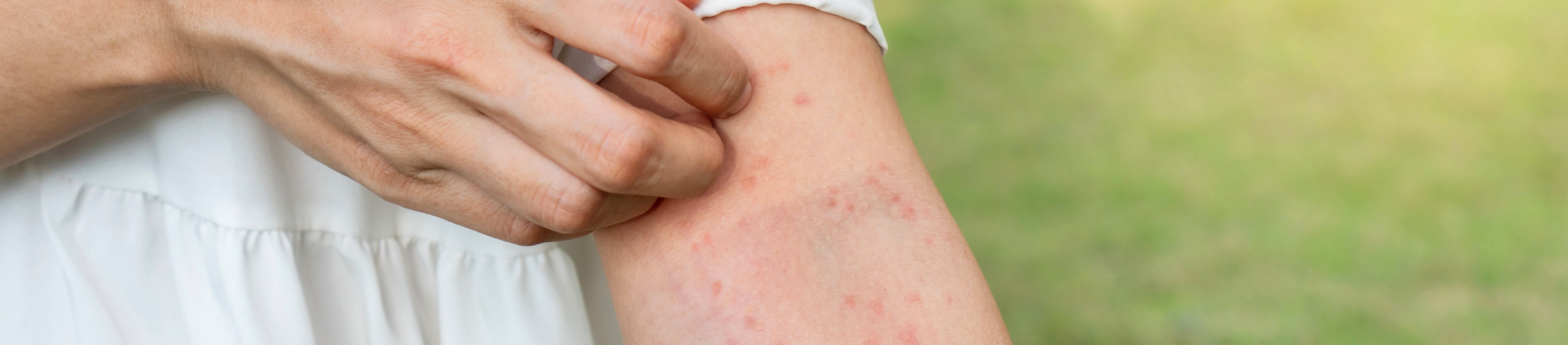 Frau kratzt Ausschlag am Arm