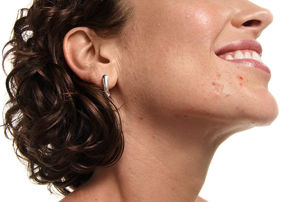 a woman with acne prone skin