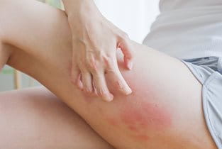 Frau kratzt sich am Unterschenkel mit roten Flecken