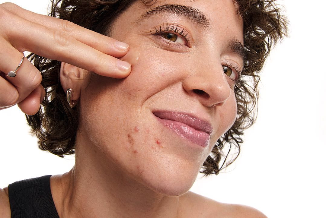 A woman touching her acne on cheeks