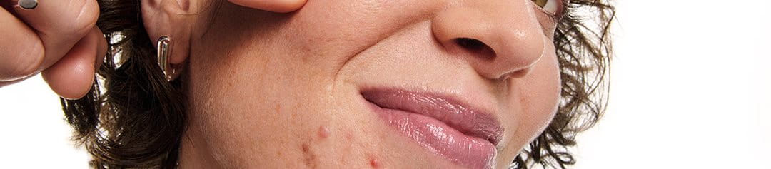 face of woman with acne