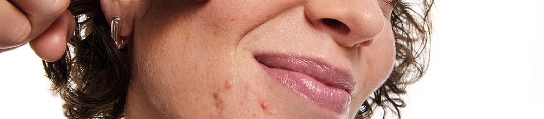 A woman touching her acne on cheecks