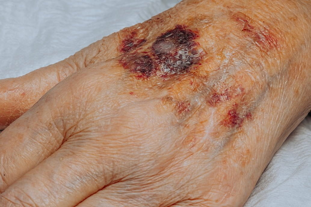 Piaga da decubito sul dorso della mano di una persona anziana, con lesione scura e pelle circostante arrossata