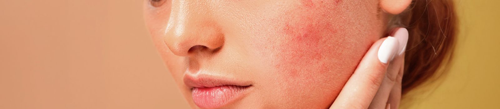 viso di una donna con dermatite