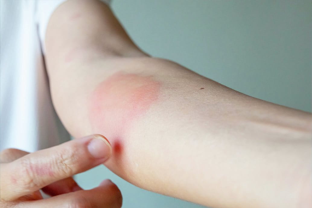 donna con eritema cutaneo sulle braccia