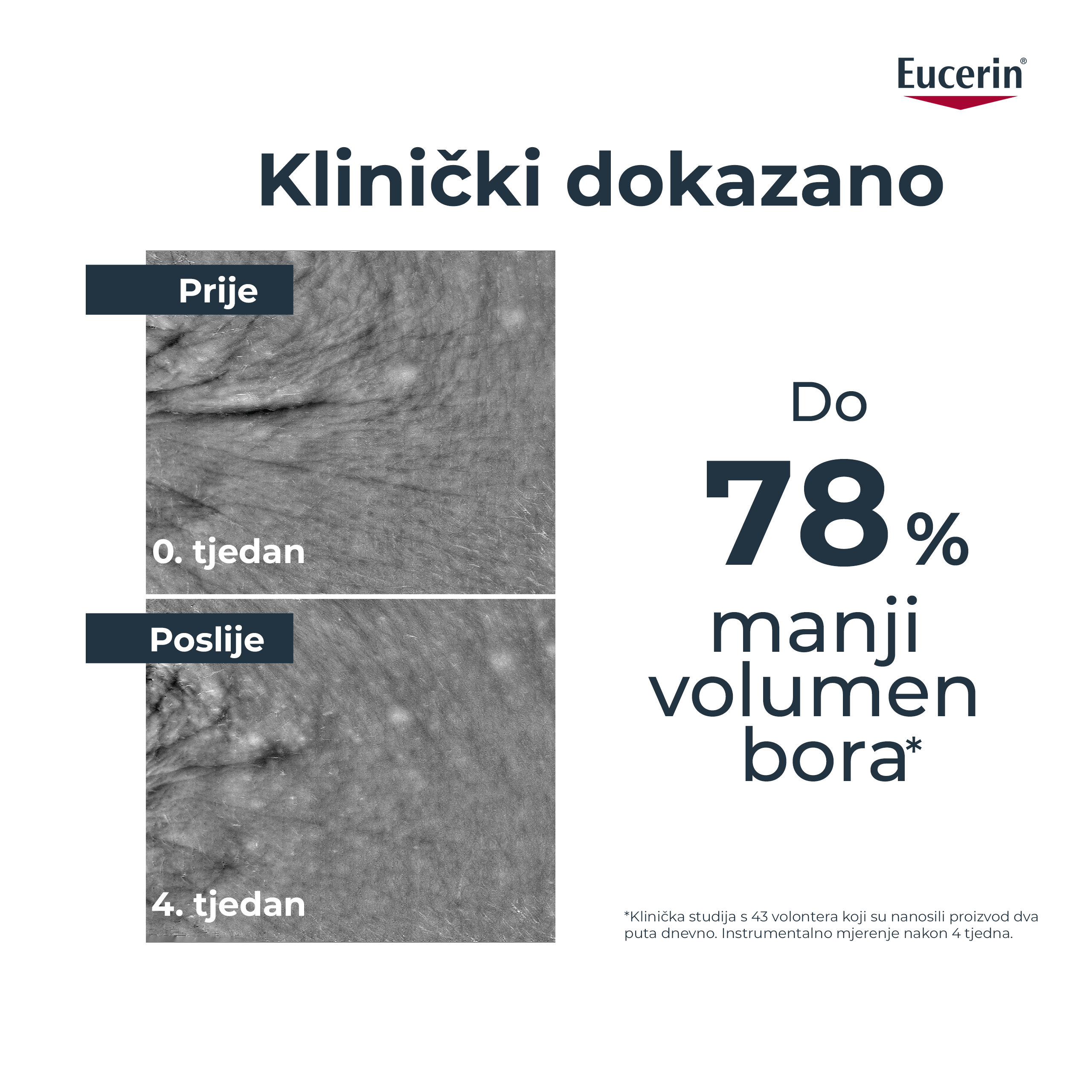 Fotografija prije i poslije koja prikazuje rezultate kliničkog ispitivanja u kojem je Hyaluron-Filler Epigenetic serum smanjio volumen bora do 78 %. 