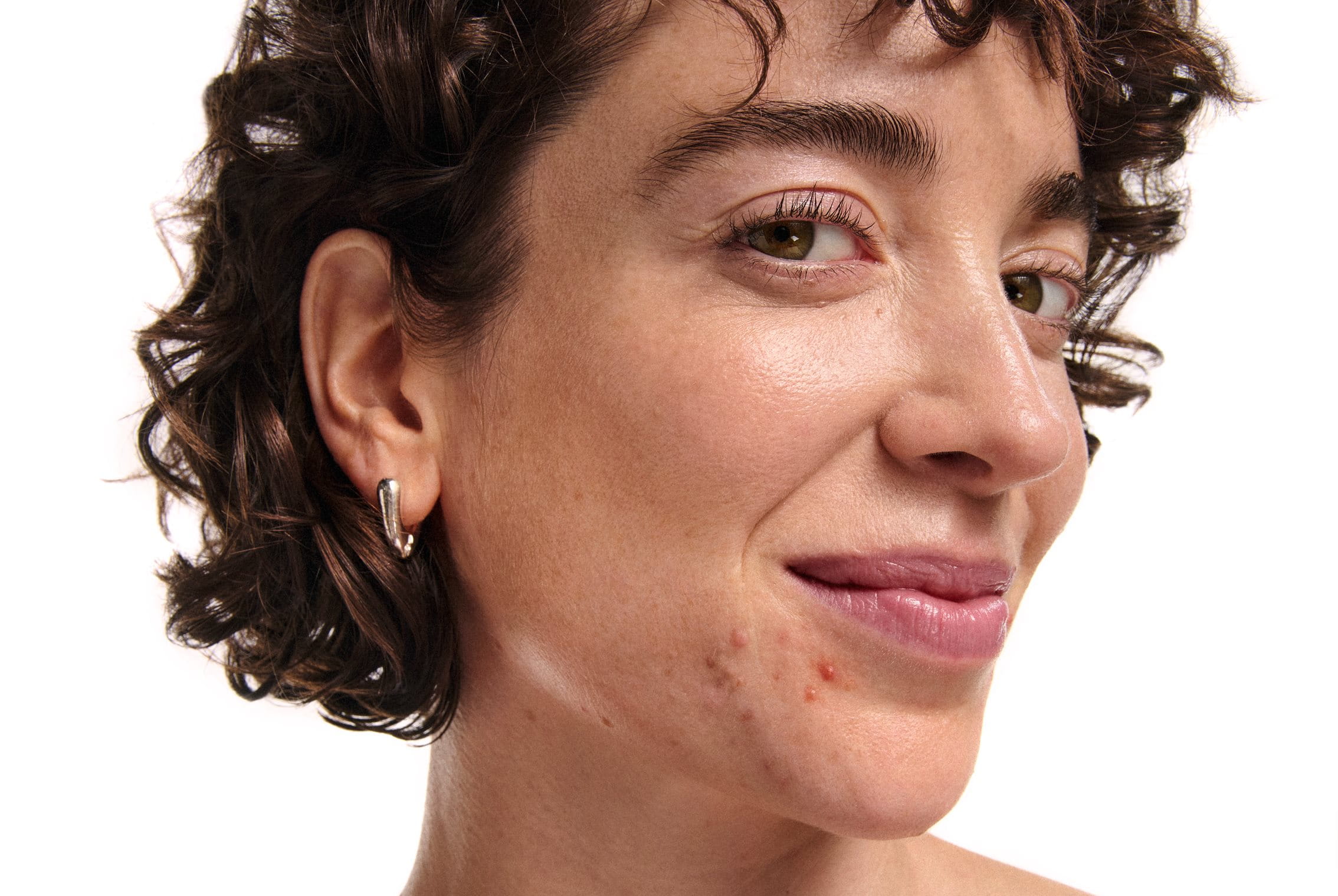 A woman with acne and sebaceous filaments around the chin