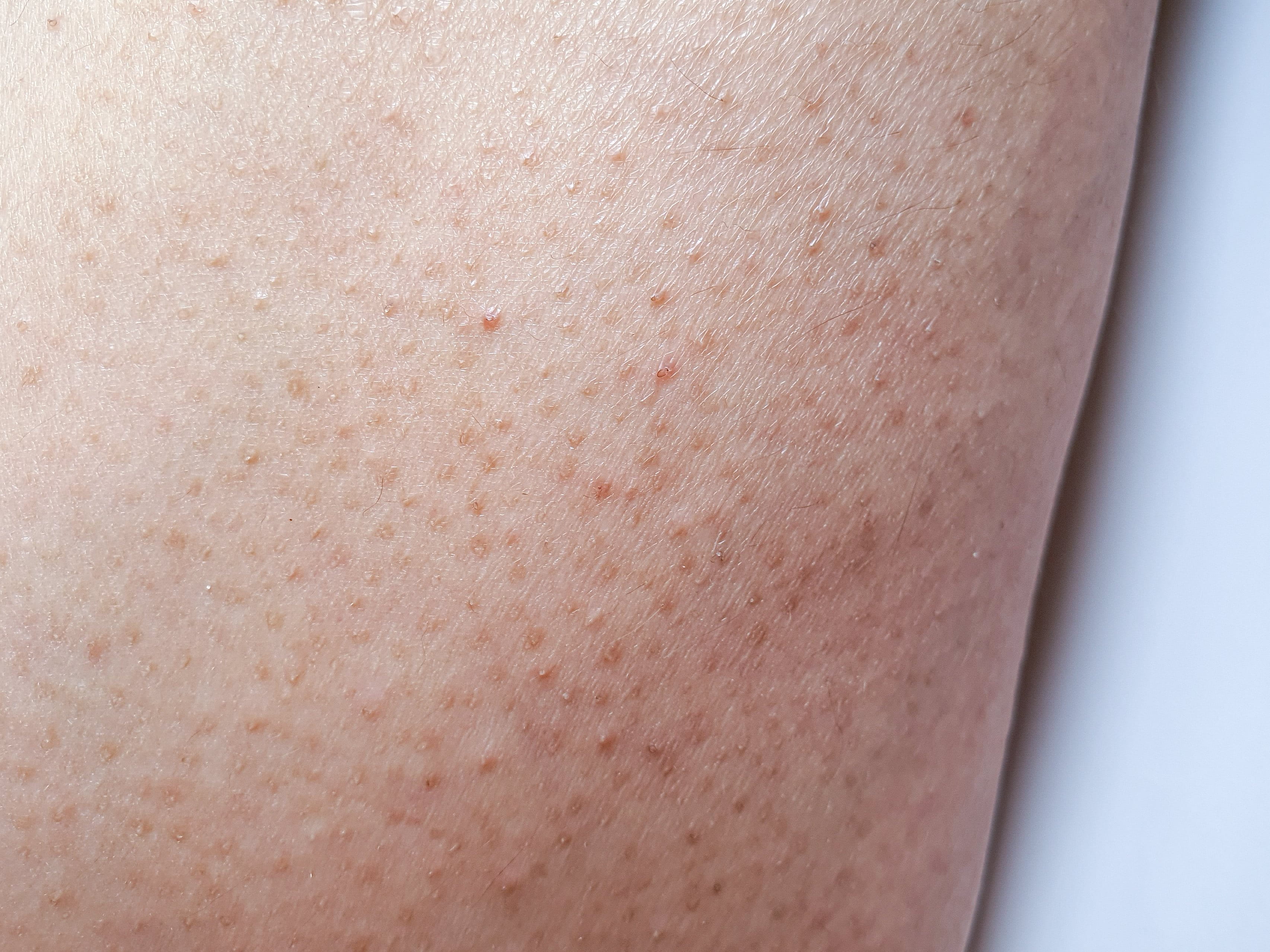 Nahaufnahme des Beins einer Frau mit Keratosis Pilaris