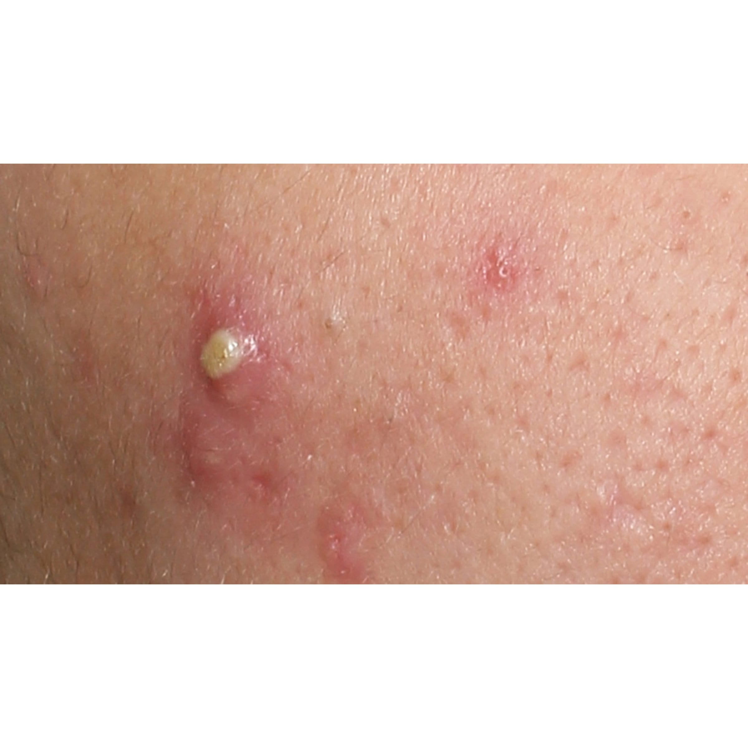 acne on cheeks