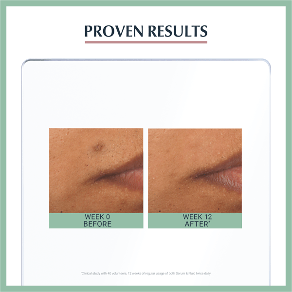 A comparison before and after using Eucerin DERMOPURE Triple Effect Serum