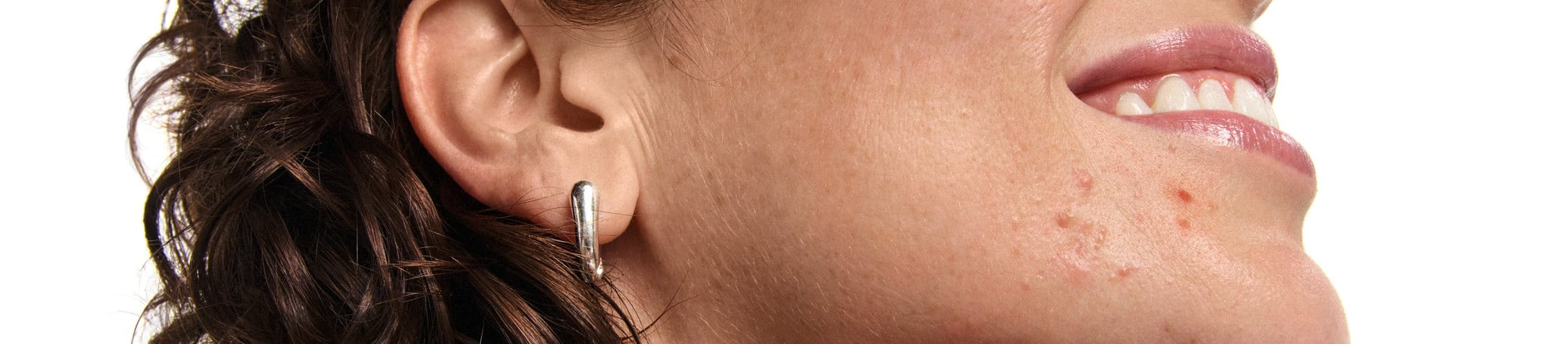 Prendre soin de la peau grasse à tendance acnéique
