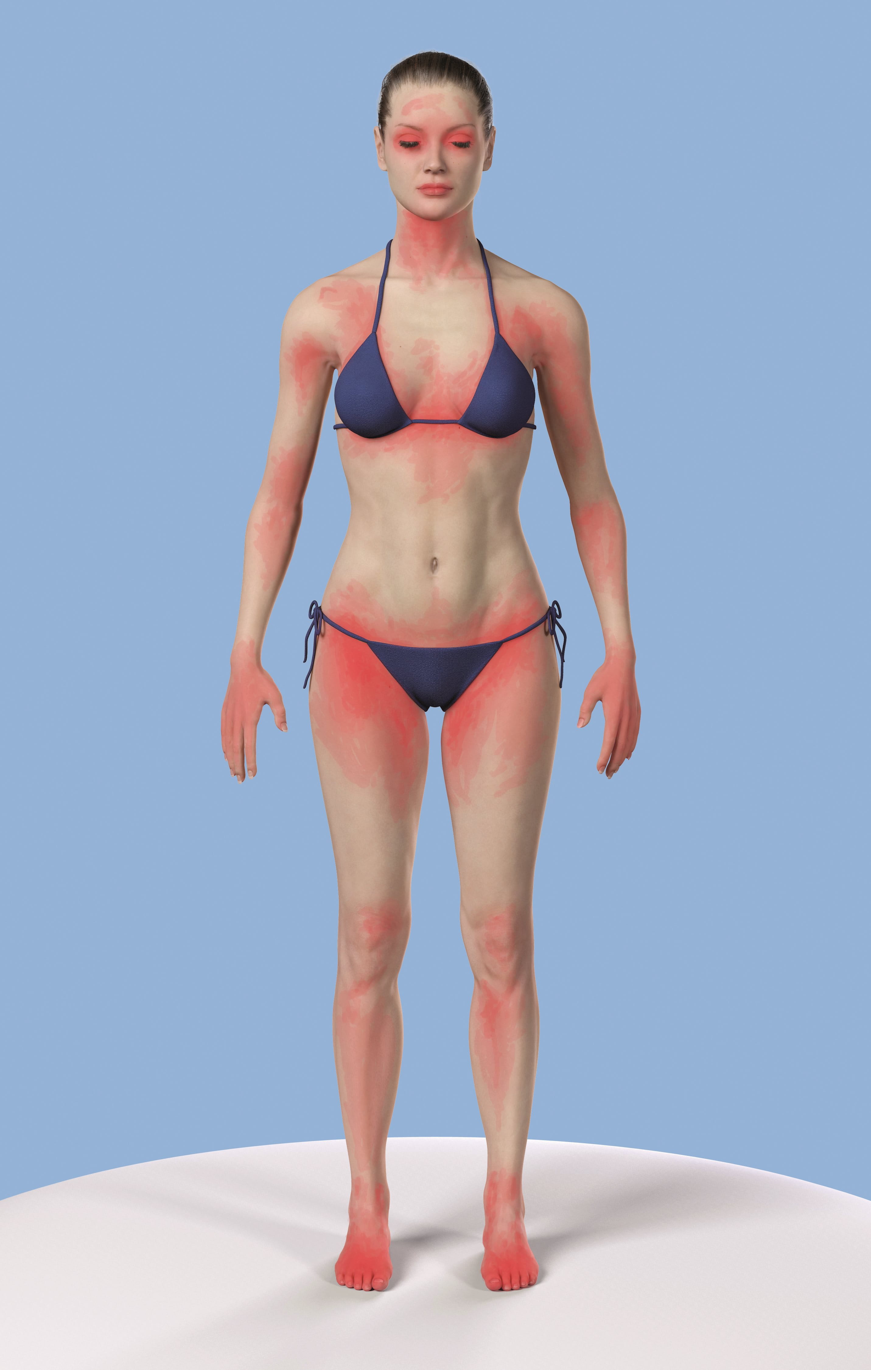 Ilustrație cu un adult – femeie, în costum de baie, văzută din față și din spate. Zonele roșii de pe piele indică arsuri solare cauzate de lipsa protecției solare adecvate. 