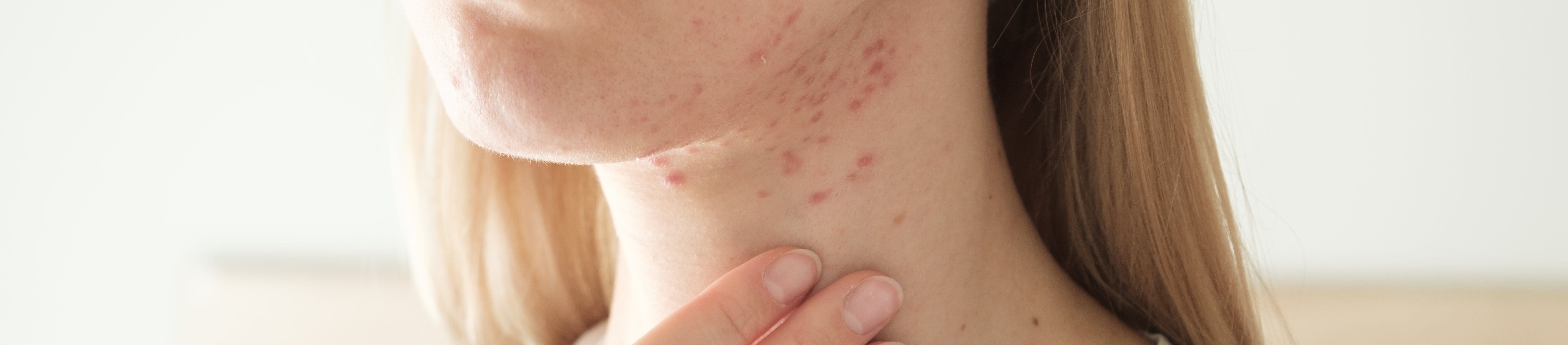 Blonde Frau in weißem T-Shirt fasst sich mit einer Hand an den Hals, auf dem Pickel zu sehen sind.