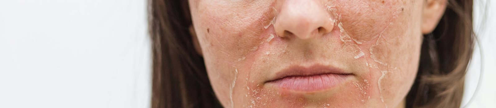 viso di donna con eritema cutaneo