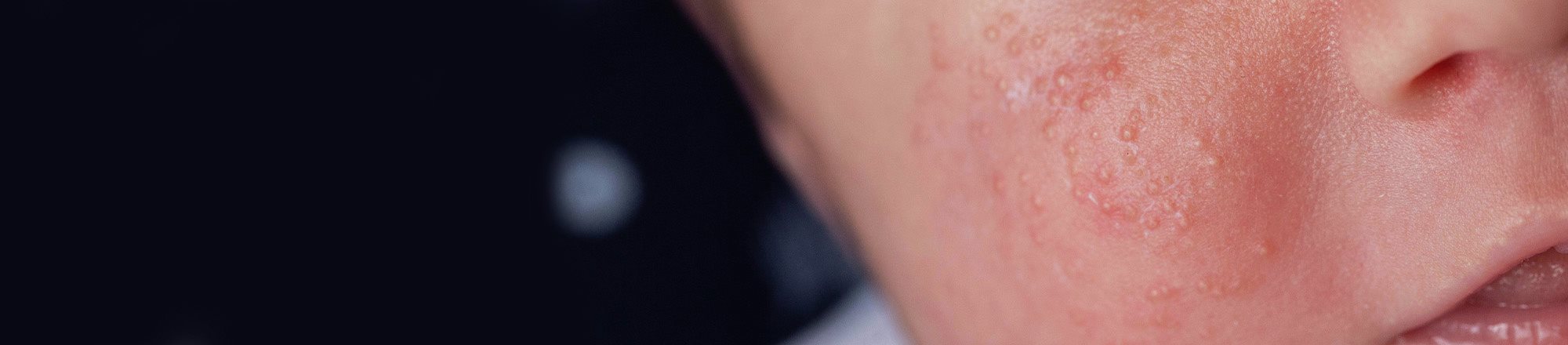 Acne neonatale sul viso di un neonato, con arrossamento e puntini cutanei tipici nei primi mesi di vita.