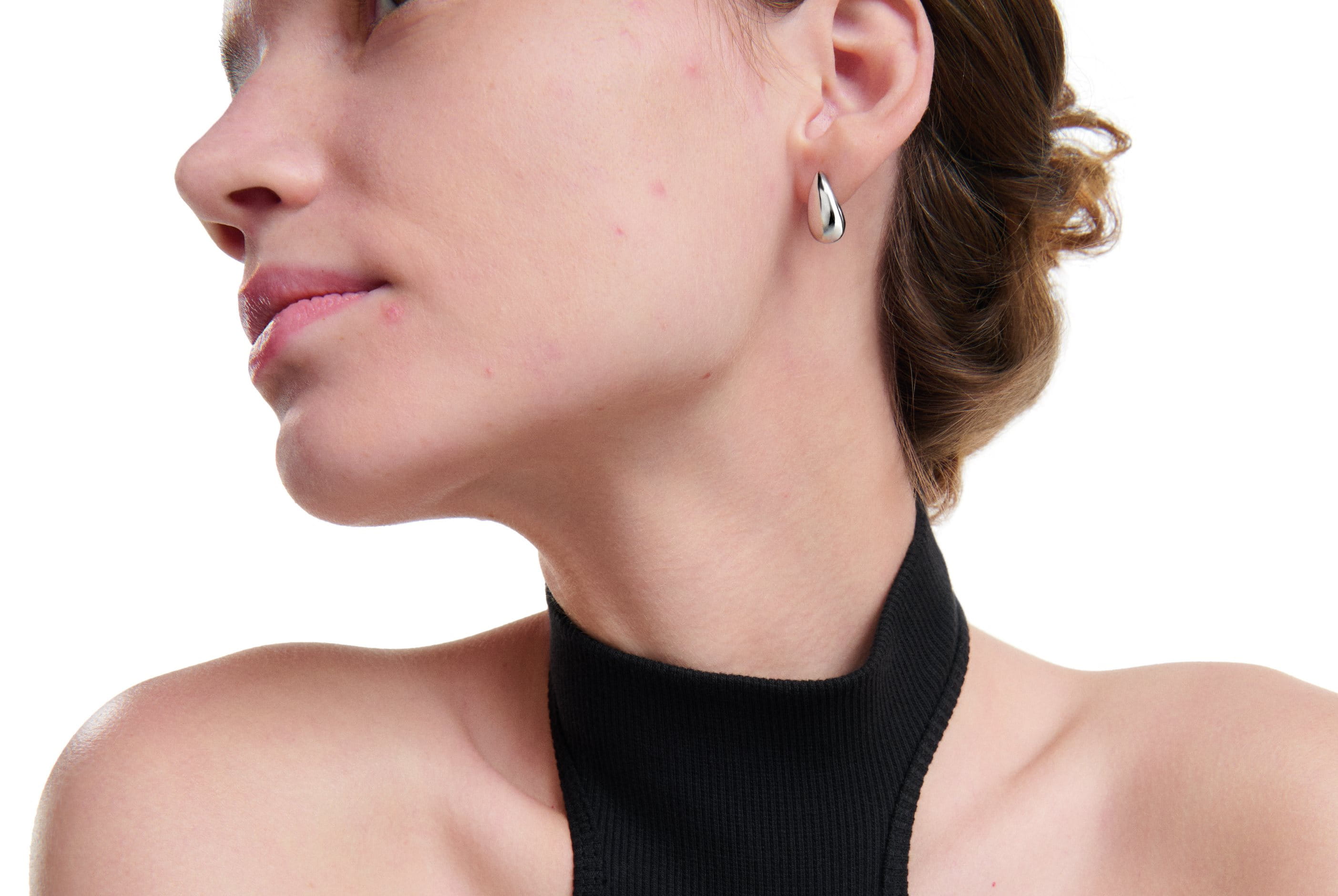 Woman with mild blemishes on acne-prone skin