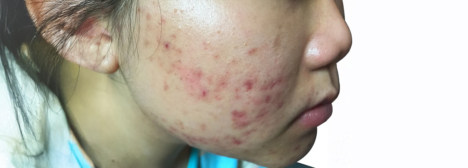 Understanding Acne and How to Care for Acne-Prone Skin