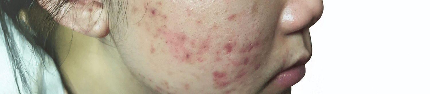 Acne Prone Skin