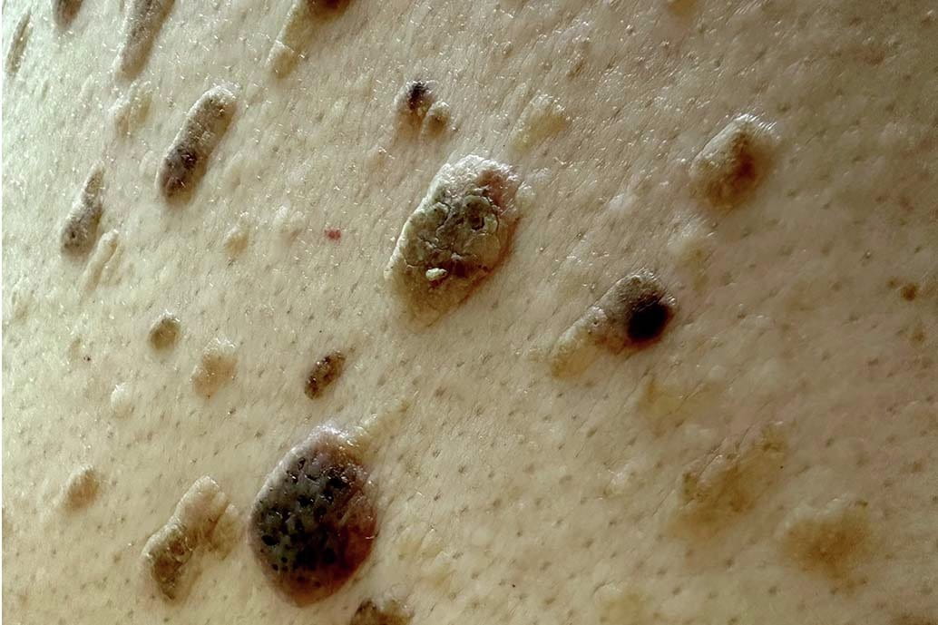 Cheratosi seborroica sul viso con multiple macchie cutanee scure benigne in età avanzata