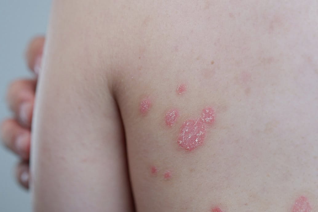Donna con lesioni da psoriasi su schiena, spalla e collo, visibili come chiazze arrossate e squamose