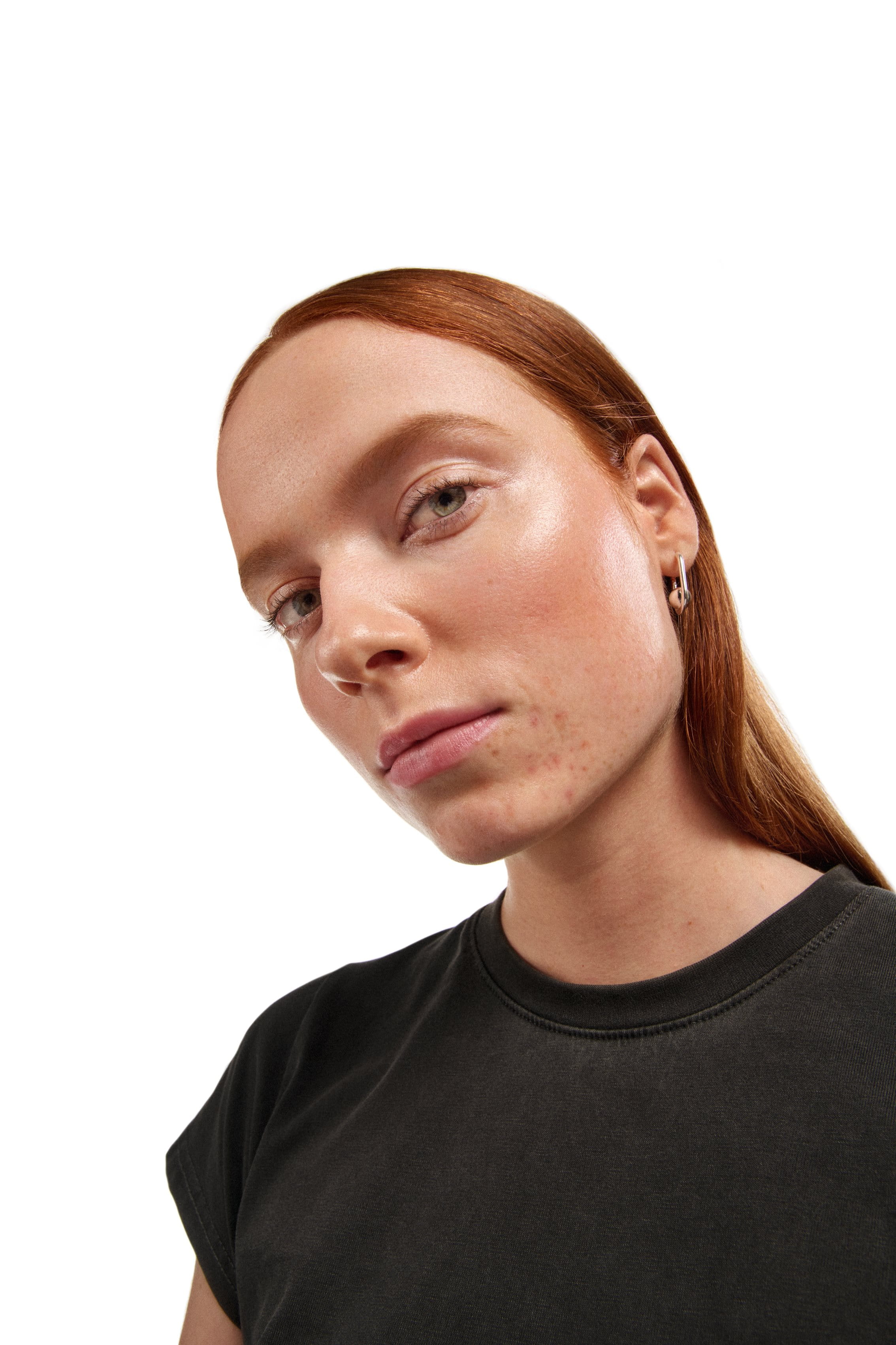 Närbild av en kvinnas ansikte med akne.