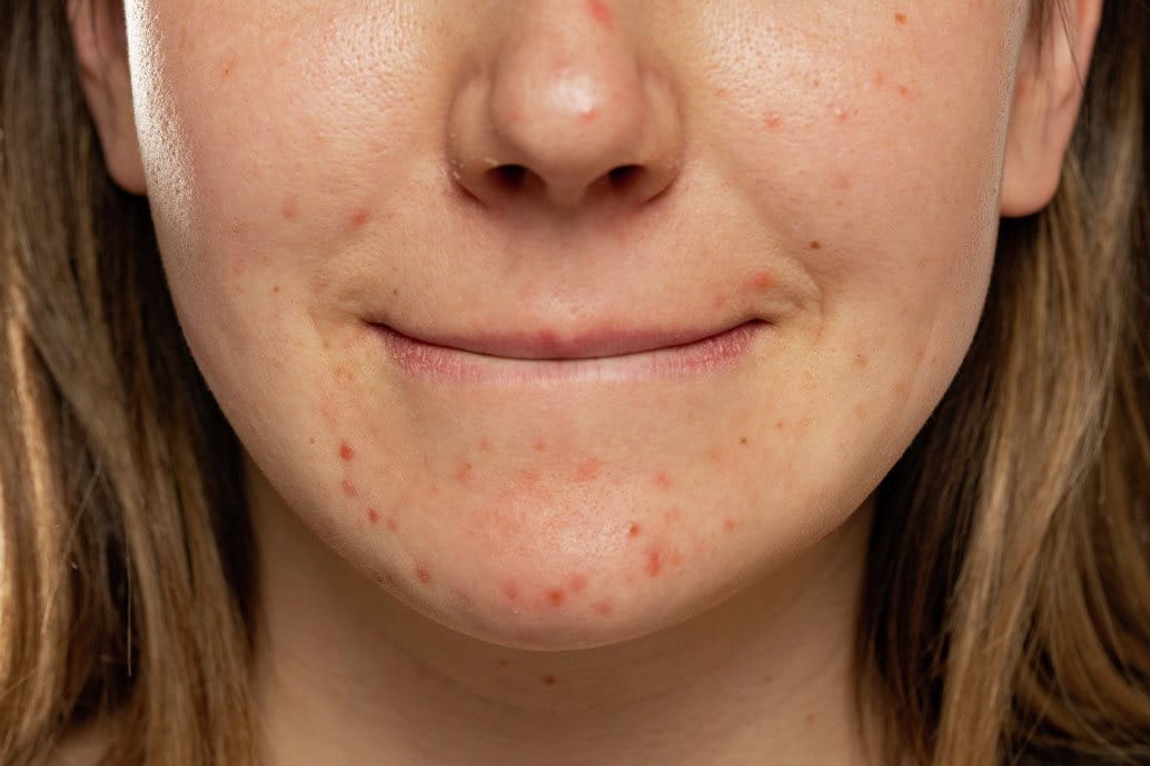 Primo piano del viso di una giovane donna con pelle a tendenza acneica, segni di brufoli e rossori